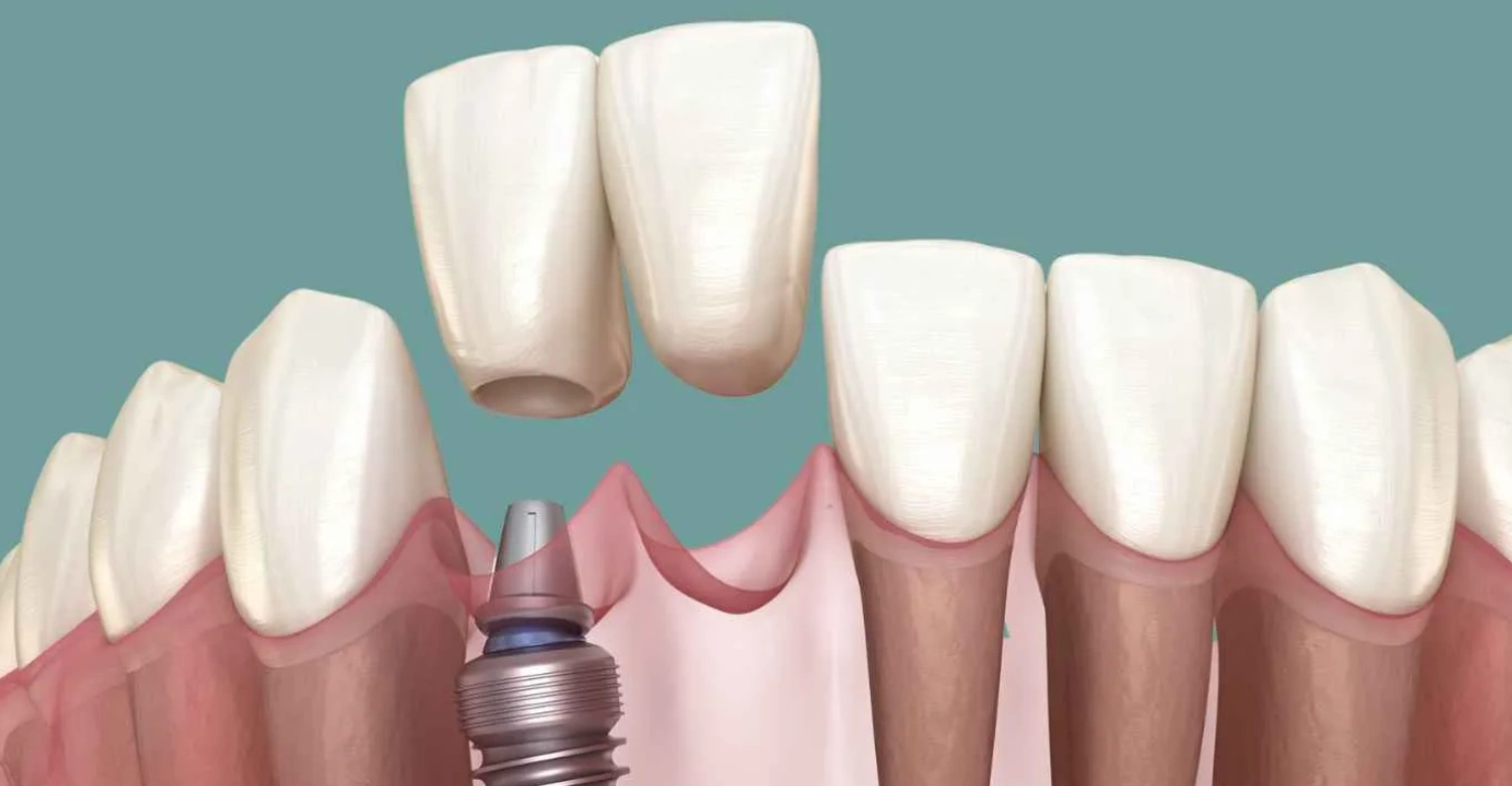 Dental Implants for Front Teeth Inblog